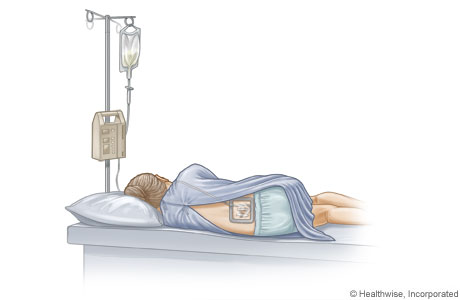 epidural 1